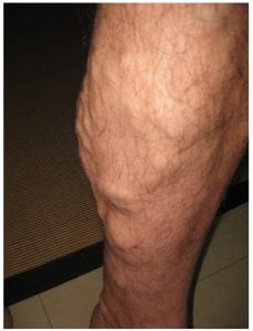 Varicose veins in leg