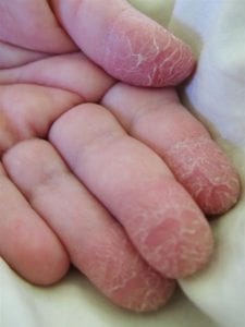 Hands With Dry Skin