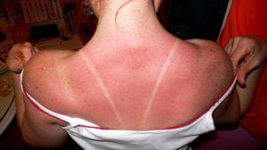 Sunburn on the back