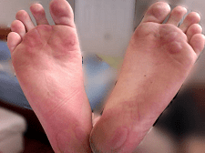 Diabetic Blisters on Feet