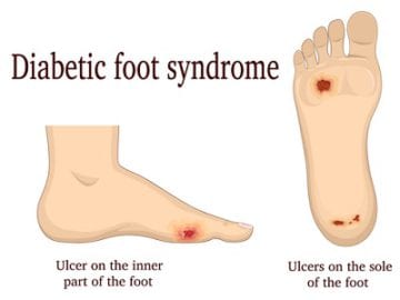 What Causes Diabetic Ulcers? | Examine your Feet Regularly