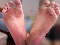 Foot Blisters